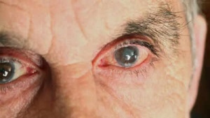 Glaucoma: Don't Ignore These Early Warning Signs – Are You at Risk?