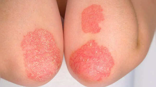 Scaly or rough patches